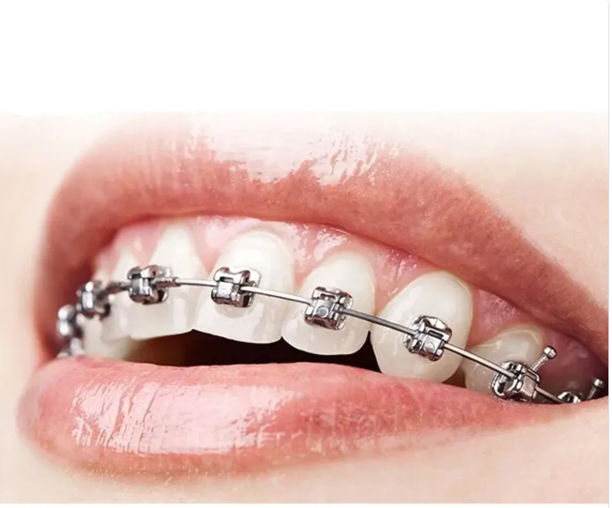 BRACKET ULTRA P MBT/ROTH