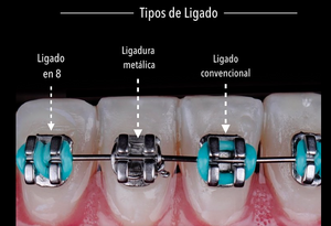 LIGADURA