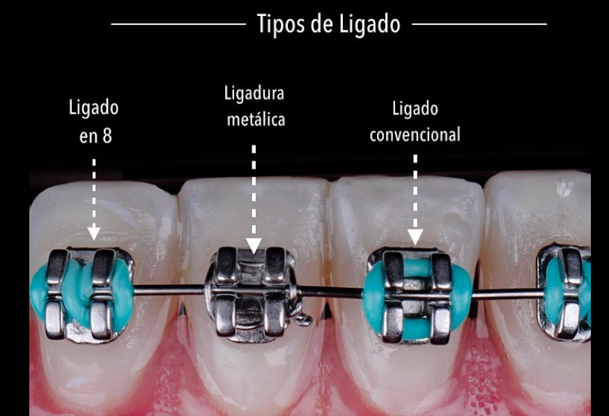 LIGADURA