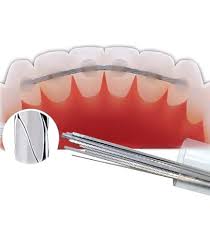 RETENEDOR DENTAL - LINGUAL X 10 UNID