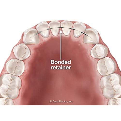 RETENEDOR DENTAL - LINGUAL X 10 UNID